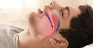 Obstructive Sleep Apnea