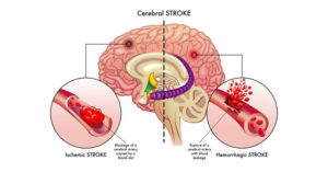 Cerebral Stroke